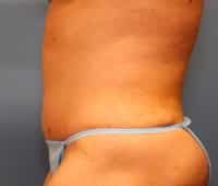 Tummy Tuck