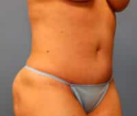 Tummy Tuck