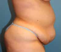 Tummy Tuck