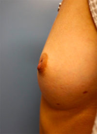 Nipple Repair/Reconstruction