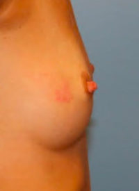 Nipple Repair/Reconstruction