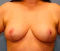 Breast Lift