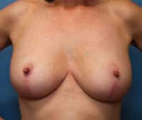 Breast Lift