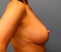 Breast Lift