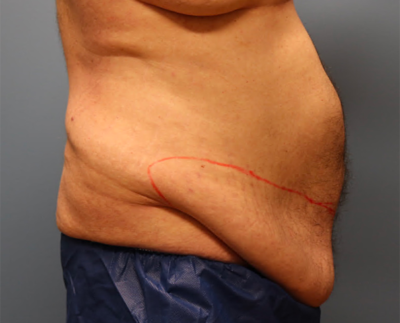 Before Complex Abdominal Wall