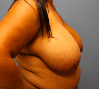 Breast Reduction