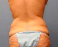 Tummy Tuck