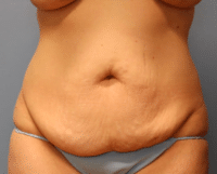 Tummy Tuck