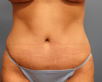 Tummy Tuck