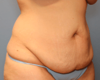 Tummy Tuck