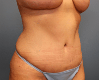 Tummy Tuck