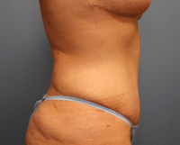 Tummy Tuck