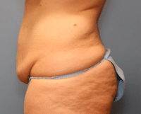 Tummy Tuck