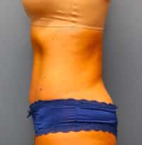 Tummy Tuck