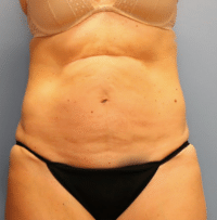 Tummy Tuck