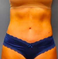 Tummy Tuck