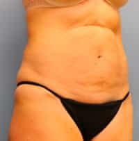 Tummy Tuck