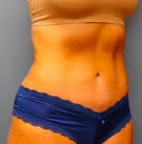 Tummy Tuck