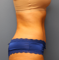 Tummy Tuck