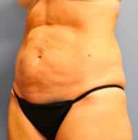 Tummy Tuck