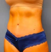 Tummy Tuck