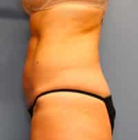 Tummy Tuck