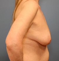 Breast Lift with Augmentation