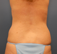 Tummy Tuck