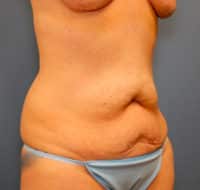 Tummy Tuck