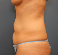 Tummy Tuck