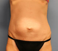 Tummy Tuck