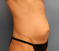 Tummy Tuck