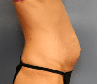 Tummy Tuck