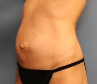 Tummy Tuck