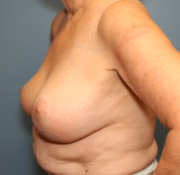 Breast Lift