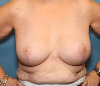 Breast Lift