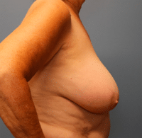 Breast Lift