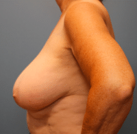 Breast Lift