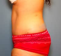 Tummy Tuck