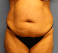 Tummy Tuck