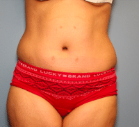 Tummy Tuck