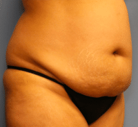 Tummy Tuck