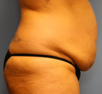 Tummy Tuck