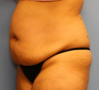 Tummy Tuck