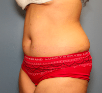 Tummy Tuck