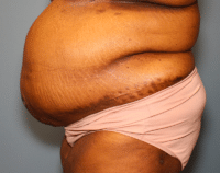 Panniculectomy