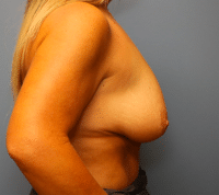 Breast Lift with Augmentation