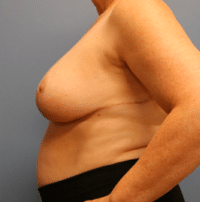 Breast Reduction