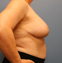 Breast Reduction