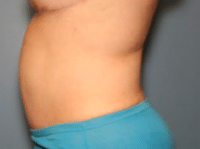 Tummy Tuck